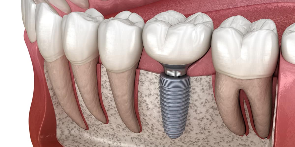 Dental Implants