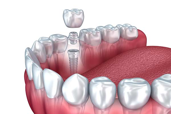 Single Dental Implant Photo