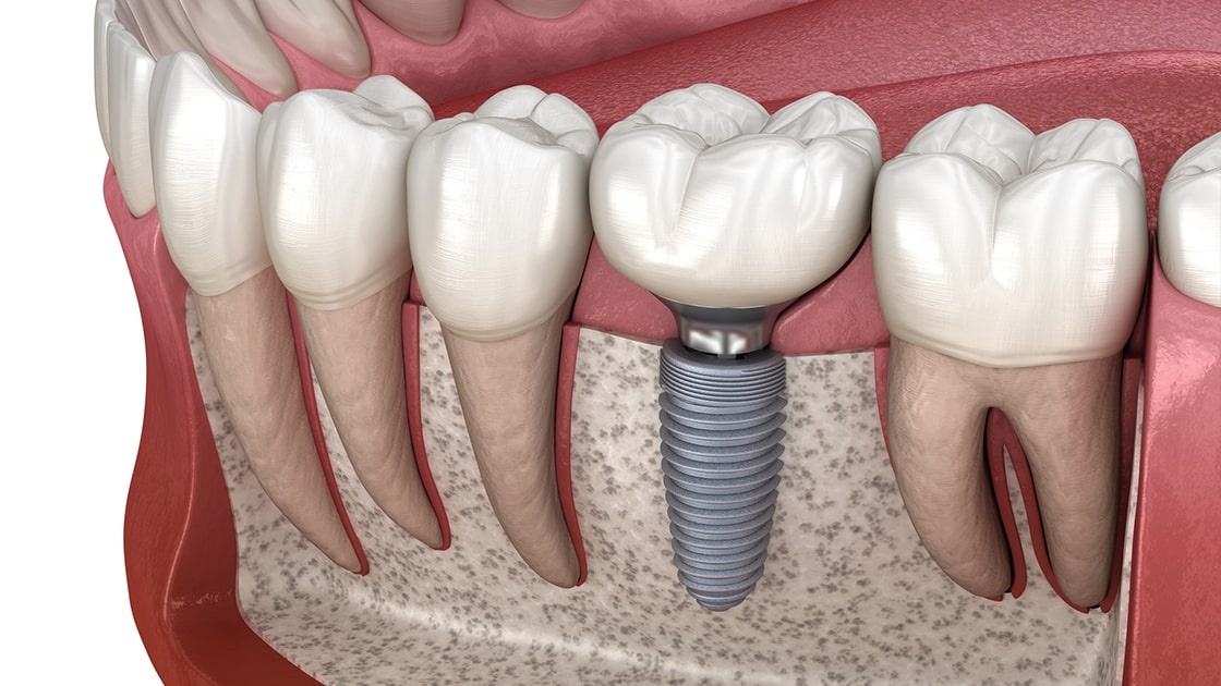 Dental Implant Photo