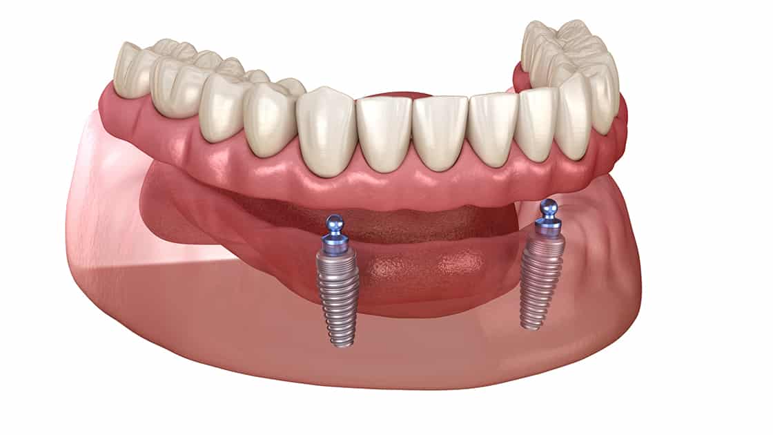 Implant Retained Dentures Photo