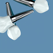 Dental Implants