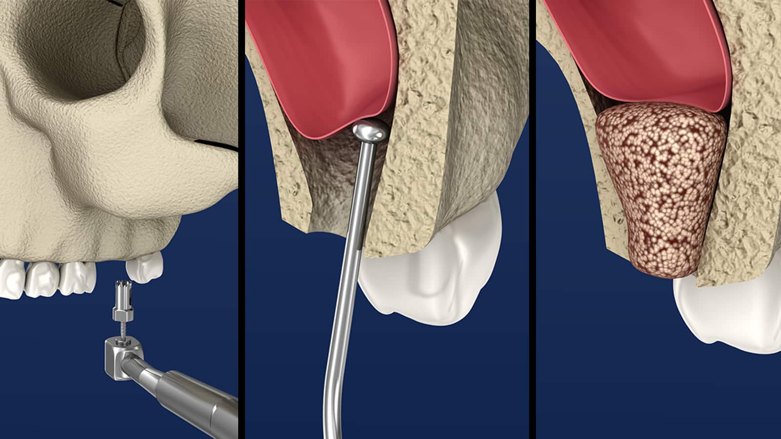 Sinus Lift Illustration