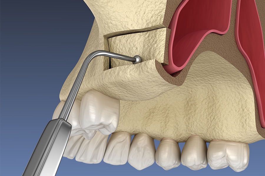 Sinus LIft Bone Removal Photo