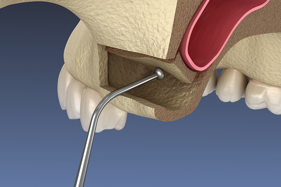 Sinus Lift Bone Opening Photo