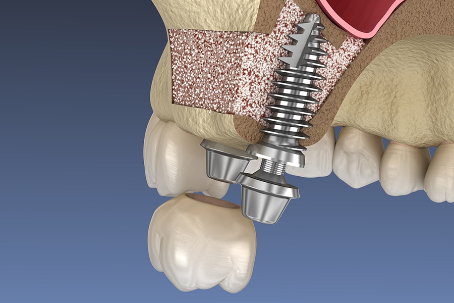 Sinus Lift Bone Graft Photo