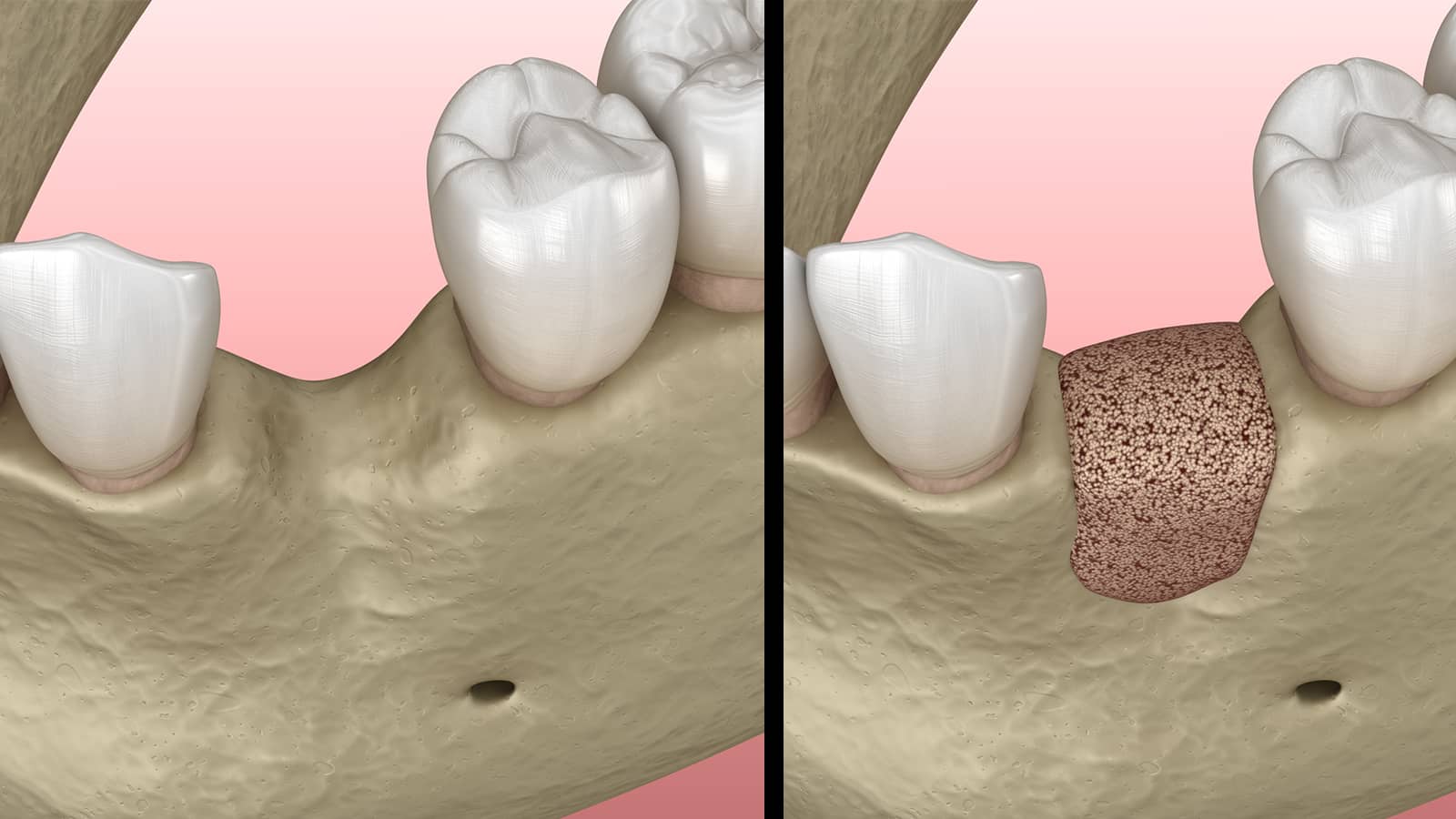 Bone Graft Photo