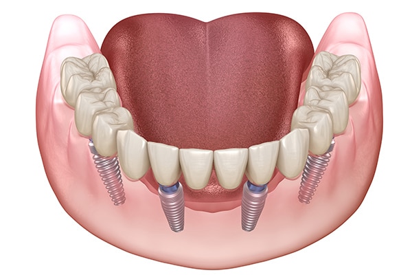 lower jaw dental implant